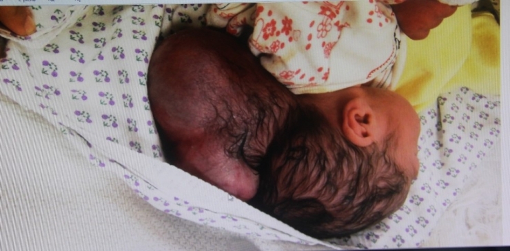 Hatay’da İki Kafalı Bebek Dünyaya Geldi