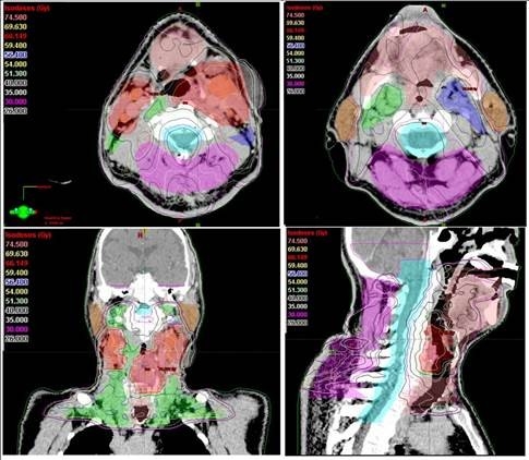 Kanser Tedavisinde ’Yapay Zeka’ Başarısı