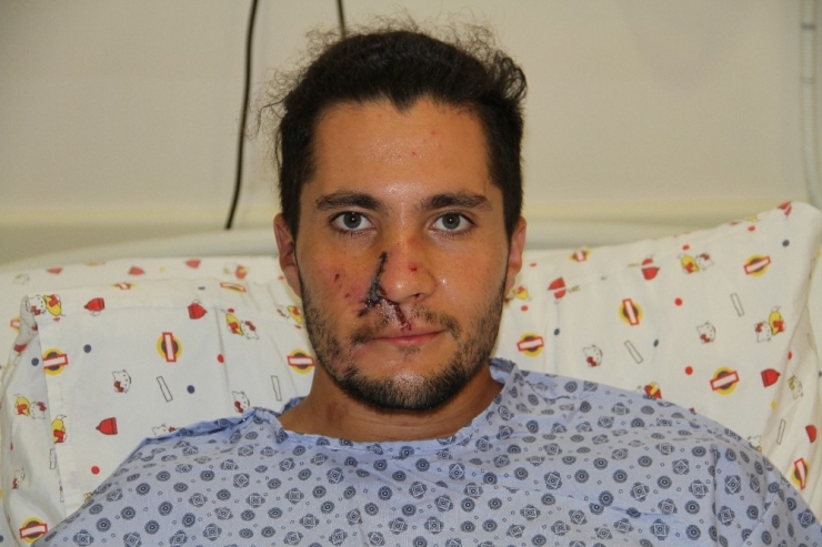 Alanya’da Kazada Burnu Kopan Rus Gence Kulağından Alınan Doku İle Burun Yapıldı
