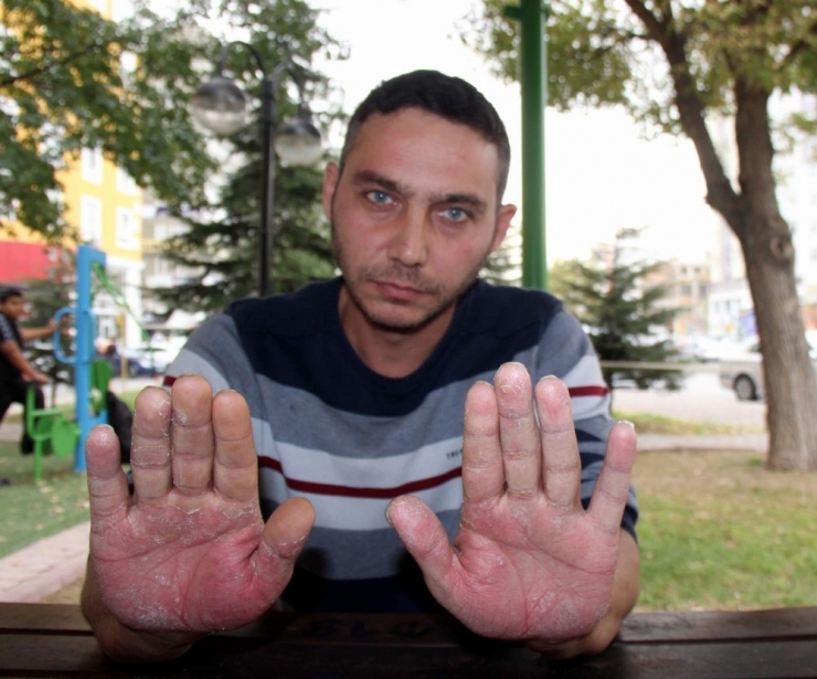 Elleri Sürekli Şişen Genç Yardım Eli Bekliyor