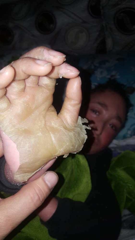 Tam 6 Yıldır Derisi Dökülüyor