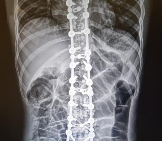 Omurga Eğriliğinden Kurtuldu