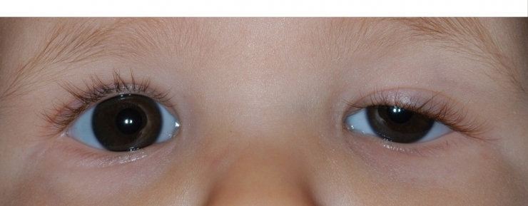 Çocuklarda Göz Kapağı Düşüklüğü Önemsenmeli