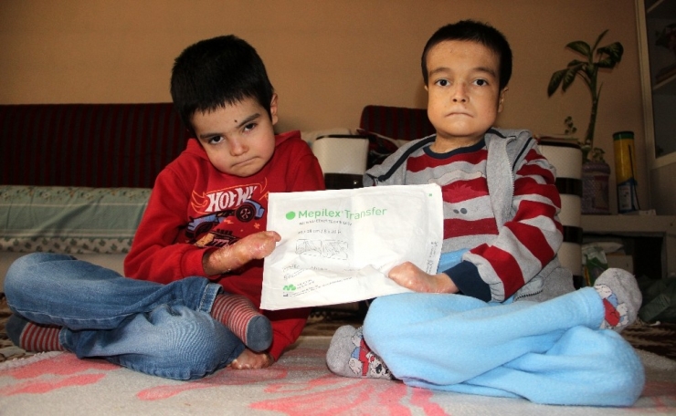 Kelebek Hastası Kardeşlerin Yürek Burkan Mücadelesi