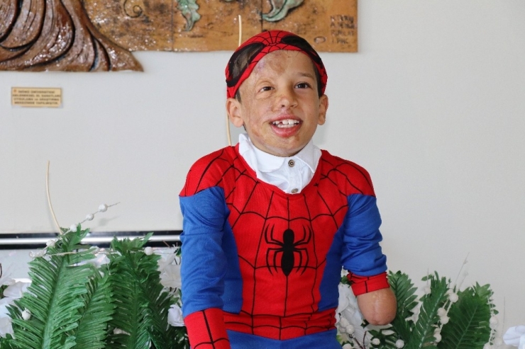 Yüz Nakli Olan Suriyeli Ahmed’in "Örümcek Adam" Hayali