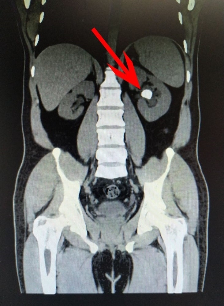 Dört Yıldır Çektiği Ağrılarından Bir Günde Kurtuldu