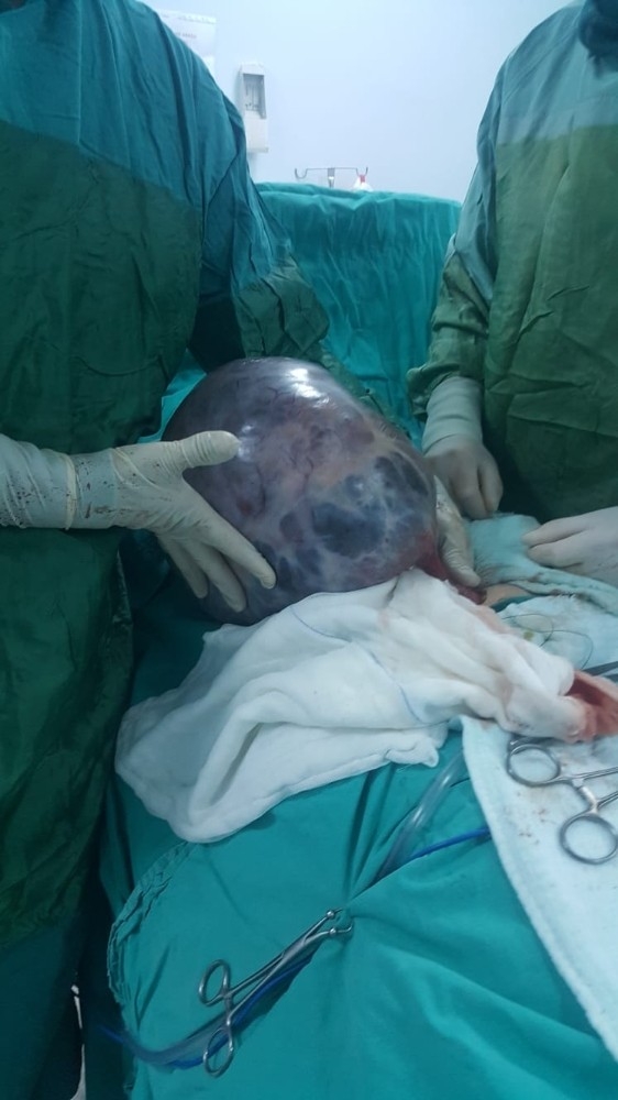 Kabızlık Şikayeti İle Gitti Karnından 30 Santimlik Kist Çıktı