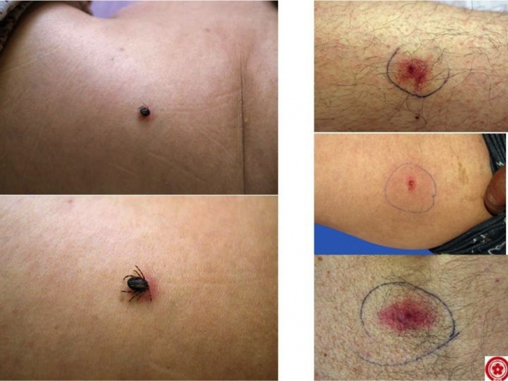 Prof. Dr. Aynur Engin: “Kkka Hastalarının Yüzde 95’i Kurtuluyor”