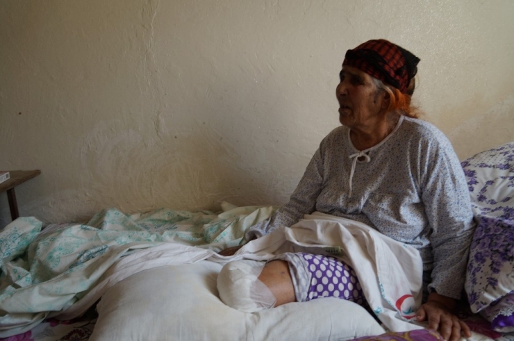 Tedavisi Gecikince Kangren Olan Bacağı Kesildi