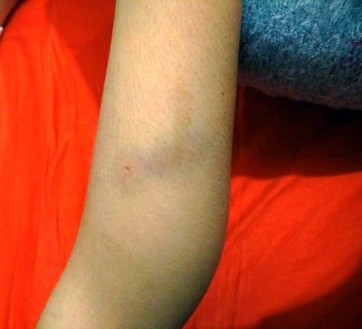 Fatsa’da Köpeğin Saldırısına Uğrayan Çocuk Yaralandı