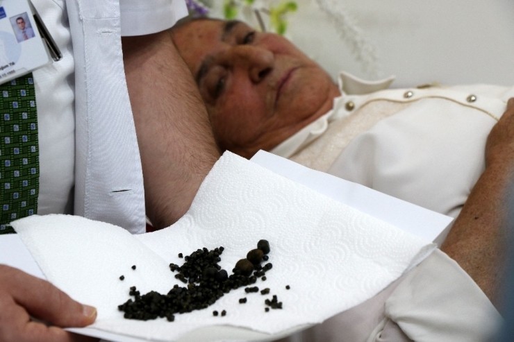 Yaşlı Kadının Safra Kesesinden 450 Tane Taş Çıktı