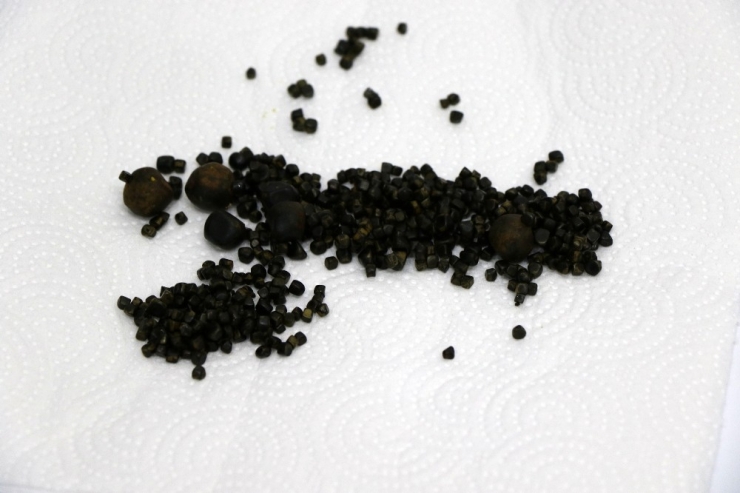 Yaşlı Kadının Safra Kesesinden 450 Tane Taş Çıktı