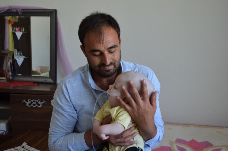 Beyninin Bir Kısmı Dışarıda Olan Bebeğe Devlet Sahip Çıktı