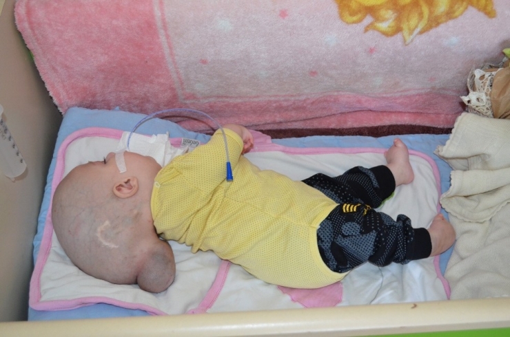 Beyninin Bir Kısmı Dışarıda Olan Bebeğe Devlet Sahip Çıktı