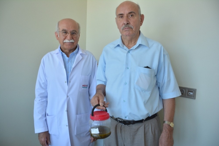 Safra Kesesinden Sayılamayacak Kadar Çok Sayıda Taş Çıktı