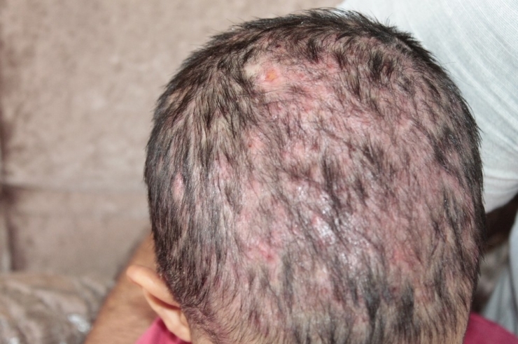 Kafa Derisinde Yaralar Çıkan 3 Yaşındaki Lorin’in Tedavisine Başlandı