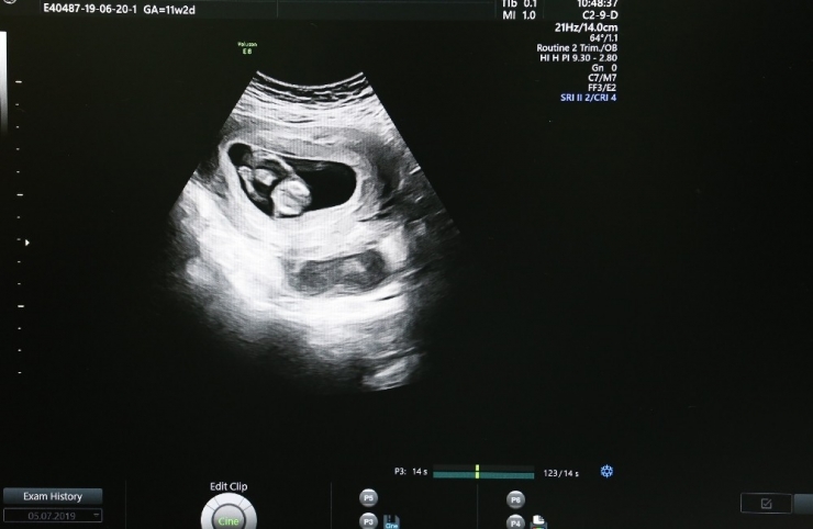 Riskli Gebeliklerin Takibi Kolaylıkla Yapılabilecek