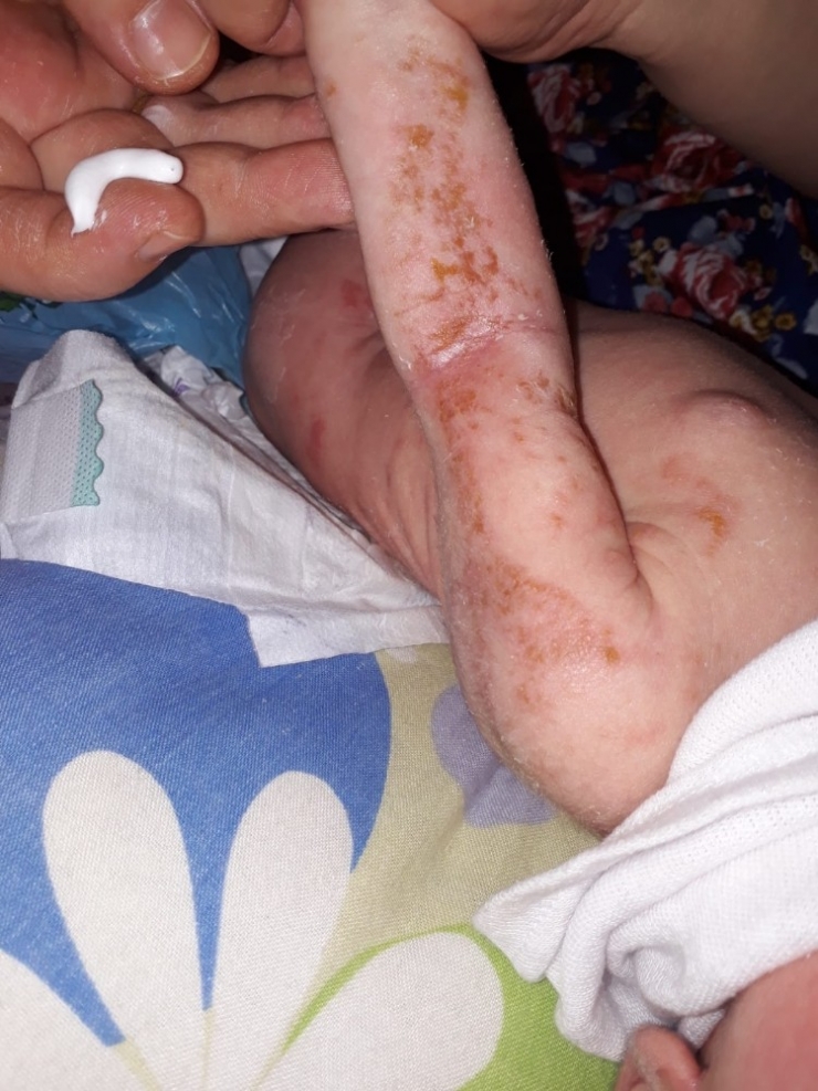 8 Aylık Rukiye Vücudunu Kapayan Yaralarla Mücadele Ediyor