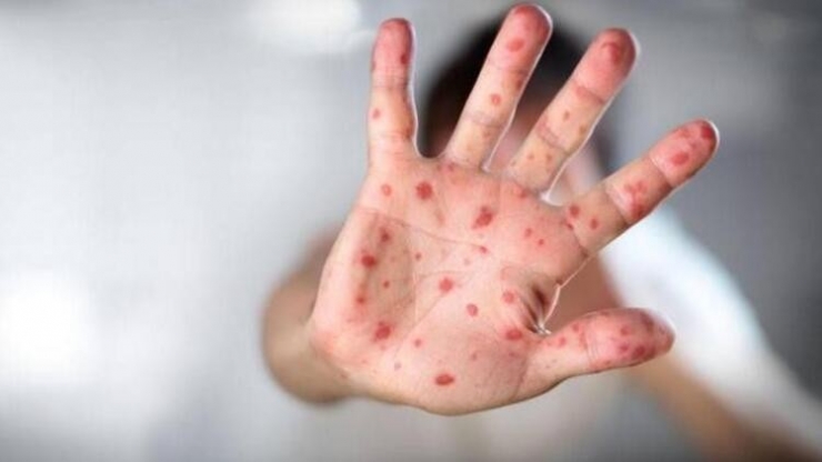 Çocuklarda El-ayak-ağız Hastalığı Hastalığına Dikkat