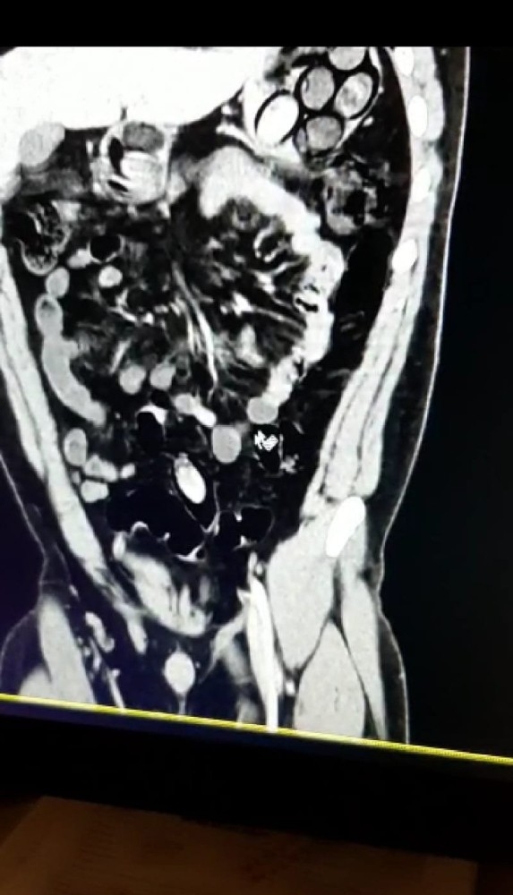 Antalya’ya Midesinde Taşıdığı 45 Kapsül Uyuşturucu İle Geldi