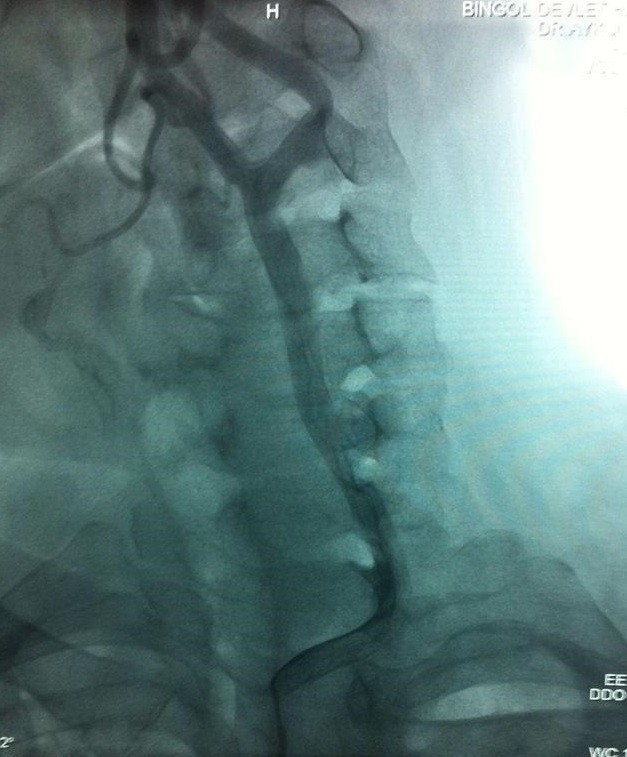 Bingöl’de İlk Defa Şah Damarı Anjiyografisi