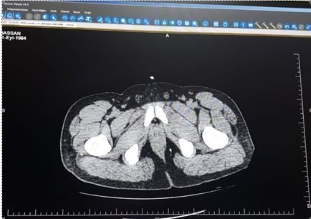 İran’dan Midesinde Eroin Getiren Şahsı Polis Yakaladı