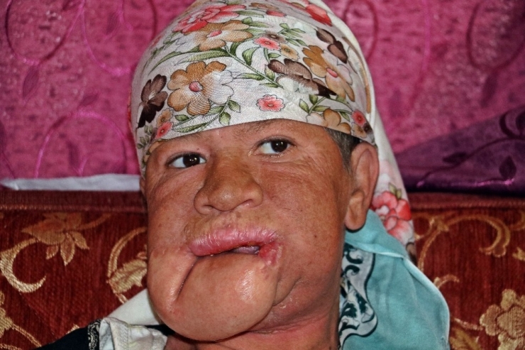 Çenesinde Çıkan Sivilce Hayatını Kararttı, Kızının Derdine Düştü