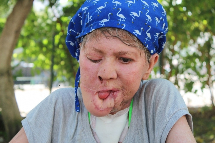 Çenesinde Çıkan Sivilce Hayatını Kararttı, Kızının Derdine Düştü