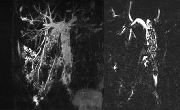 Safra Yollarından 100’den Fazla Taş Ameliyatsız Çıkarıldı