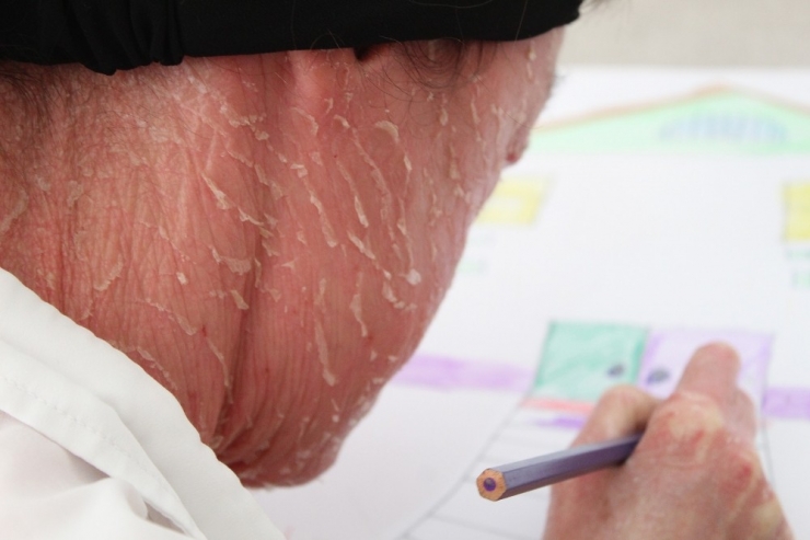 Balık Pulu Hastası Medine, Dört Gözle Beklediği İlacı Gördü, İsyan Etti