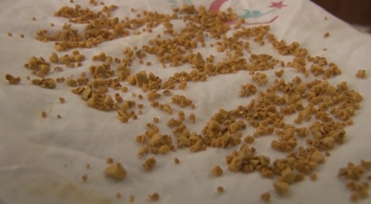 Safra Kesesinden Bin 50 Taş Çıktı