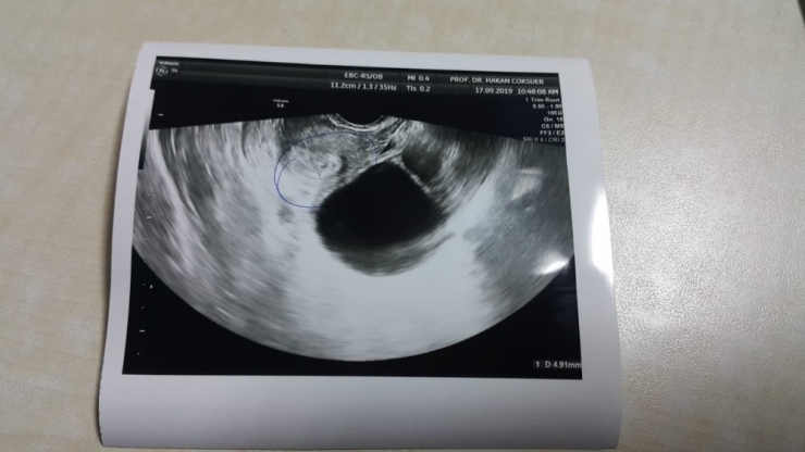 Avrupa’da Başvurmadık Yer Bırakmayan Alp Ailesi, Diyarbakır’da Çocuk Sahibi Oldu