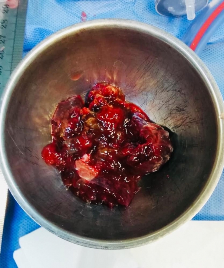 Batman’da Bir Hastanın Kalbinden Mandalina Büyüklüğünde Tümör Çıkarıldı