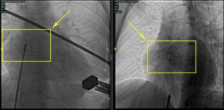 Doğuştan Kalbi Delik Olan Genç Kadın 30 Dakikada Sağlığına Kavuştu
