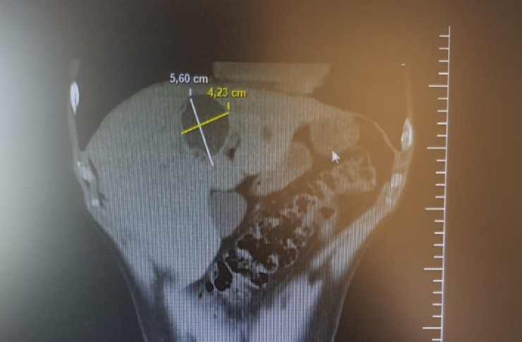 Karaciğerideki Kistten 3 Saatlik Operasyonla Kurtuldu