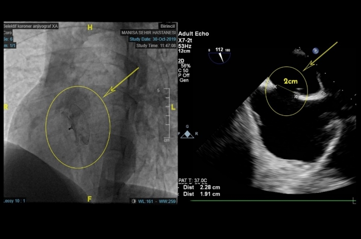 Kalbindeki Delik Ameliyatsız Kapatıldı