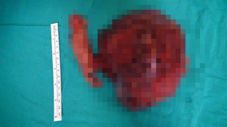 14 Yaşındaki Çocuktan 1,5 Kiloluk Ur Çıktı