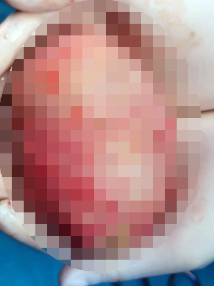 Rahminden 15 Santimlik Miyom Çıktı