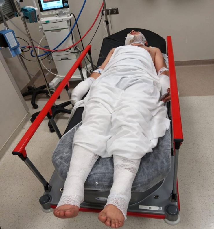 Evi Yakmak İsterken Kendini Ve Arkadaşlarını Yaktı