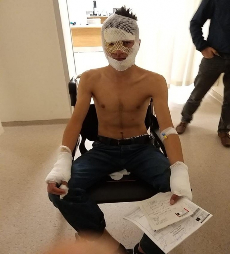 Evi Yakmak İsterken Kendini Ve Arkadaşlarını Yaktı