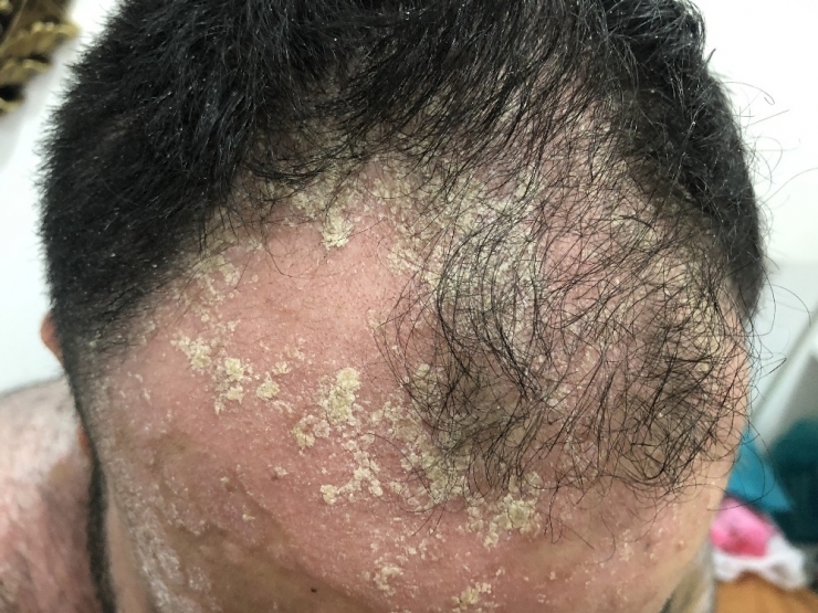 Tüm Vücudunu Sedef Saran Hasta Derdine Ankara’da Çare Arıyor