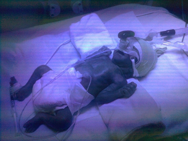 900 Gram Doğdu, Yaşam Savaşını Kazandı, Şimdi 5 Yaşında