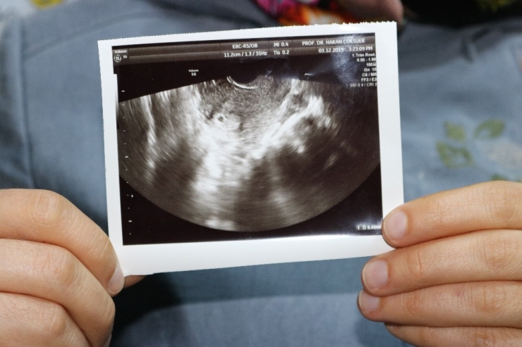 11 Yıllık Çocuk Hasreti Glutatyon Tedavisiyle Son Buldu