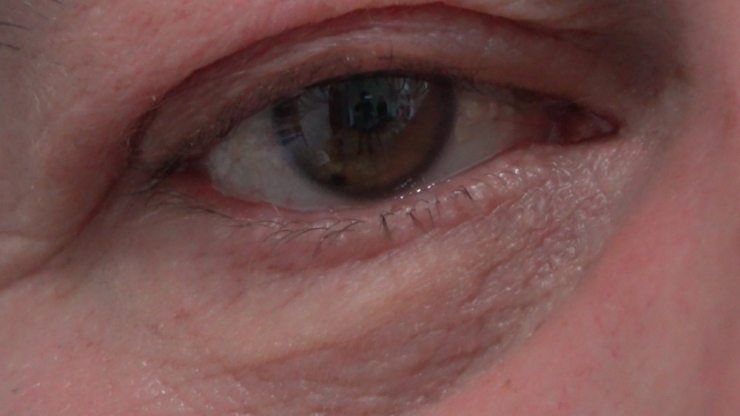 Avustralya’dan Geldi, Gözlüklerinden ’Akıllı Lens’ İle Kurtuldu