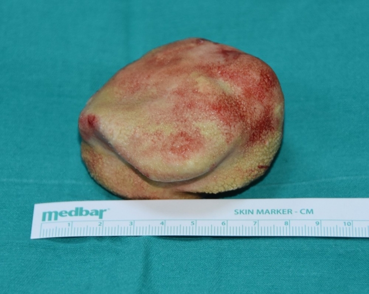 12 Yaşındaki Çocuğun Testislerinden 350 Gram Ağırlığında Taş Çıkartıldı