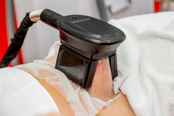 Soğuk Lipoliz İle Bölgesel İncelme