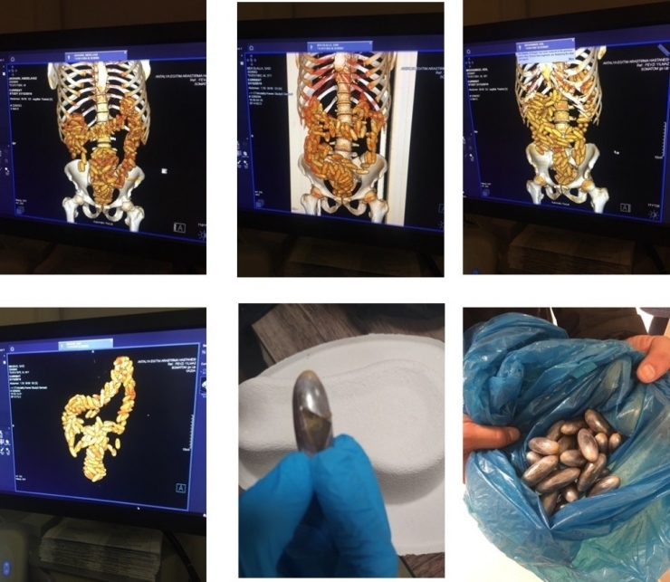 Midelerinde Ve Bağırsaklarında 400 Kapsül Uyuşturucuyla Havalimanında Yakalandılar