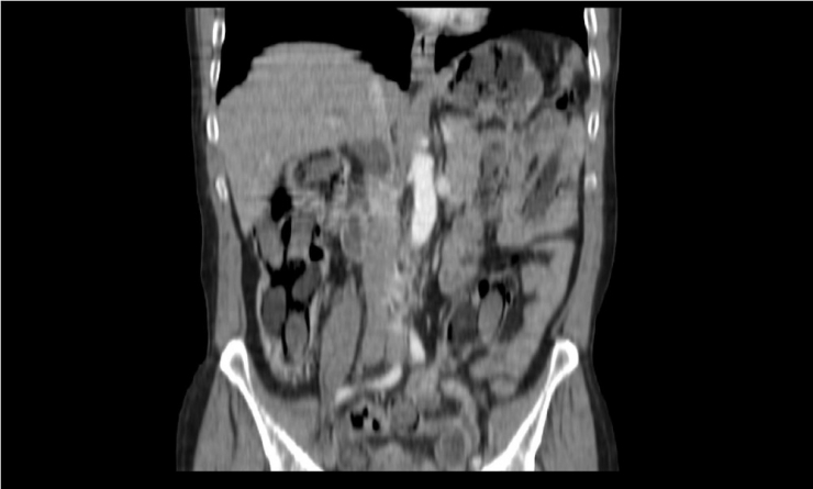 İran Uyruklu Zanlı, Yuttuğu 48 Paket Eroini Hastanede Bir Haftada Çıkardı