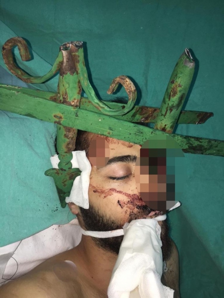 Antalya’da Gencin Yüzüne Saplanan Demir Çubuk Güçlükle Çıkarıldı