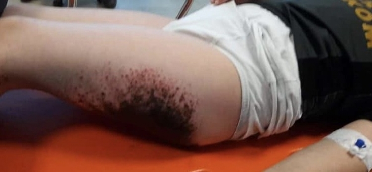 Okul Bahçesinde Oynayan Öğrencilerin Vücutlarında Oluşan Çürük Ve Yanıklar Sağlık Kuruluşları İle Belediyeyi Harekete Geçirdi